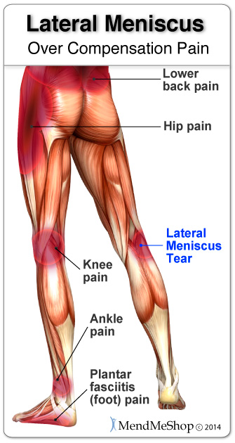 What is the recovery time for a minor meniscus tear surgery?