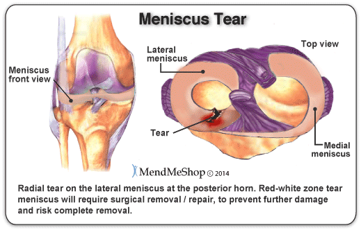 What is the recovery time for a minor meniscus tear surgery?